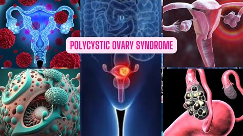 Polycystic Ovary Syndrome (PCOS): Mga Sintomas, Mga sanhi .